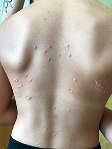 220px-Psoriasis_en_gouttes_enfant_2