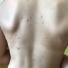 220px-Psoriasis_en_gouttes_enfant_2